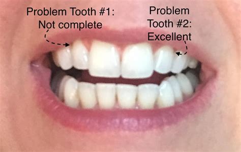 My Smile Direct Club Experience, Before & After Pict .